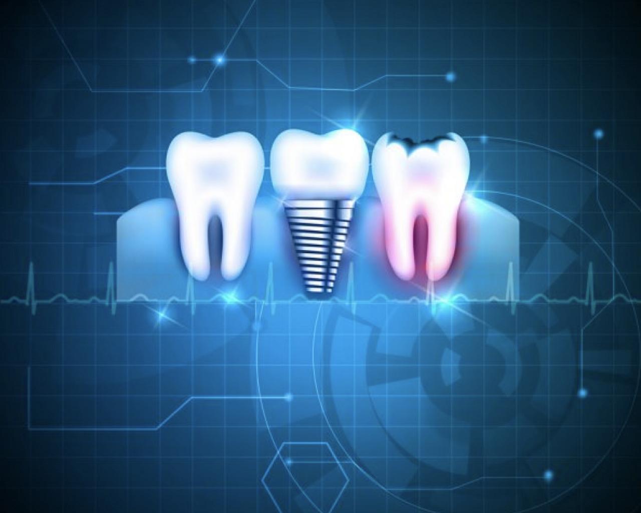 Имплантация зубов