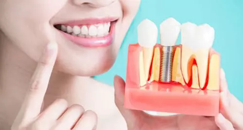 Имплант+коронка под ключ