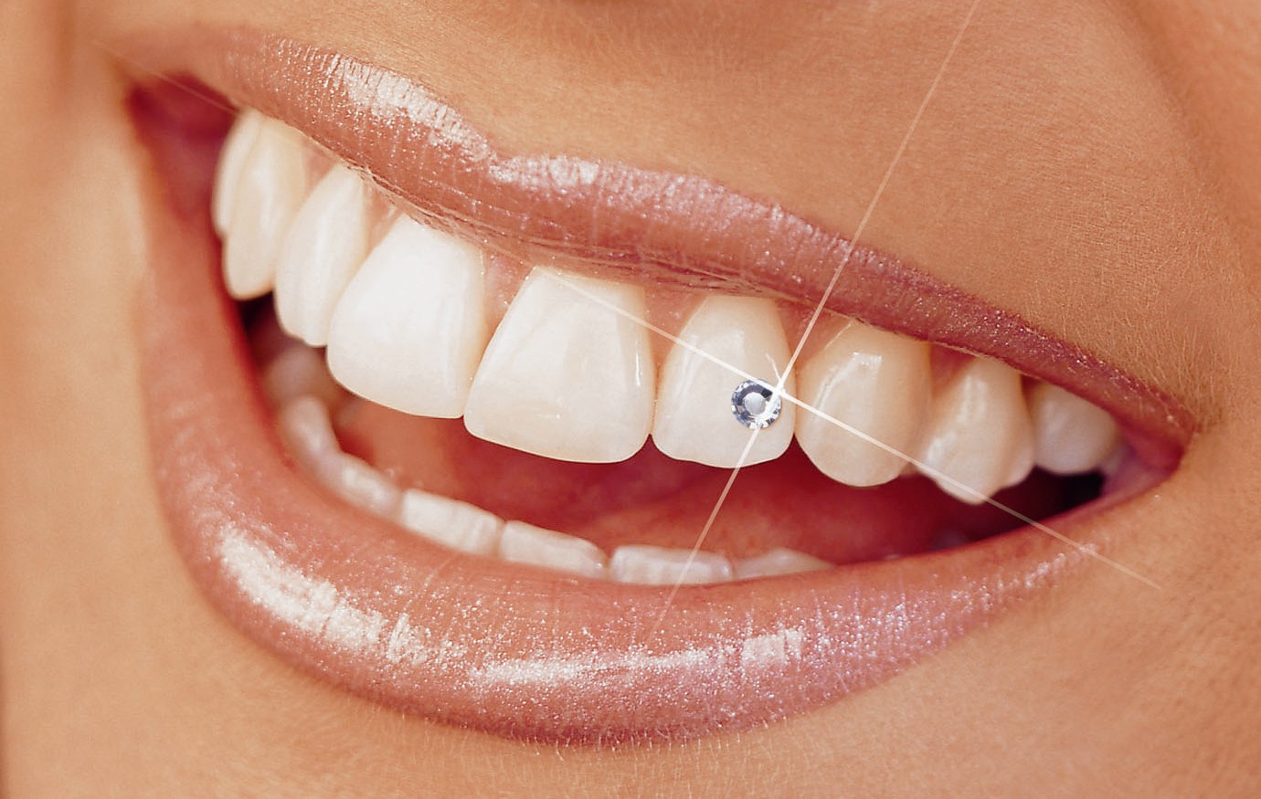 Украшение зубов бриллиантами